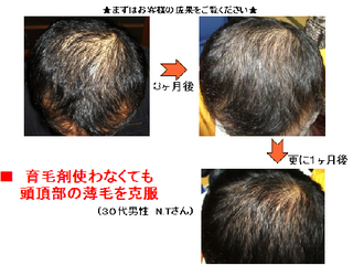 育毛の最終兵器 育毛 発毛 薄毛対策 若ハゲ対策 戸室慶次郎 内容 効果 口コミ